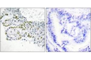 Immunohistochemistry analysis of paraffin-embedded human lung carcinoma, using PKC delta (Phospho-Tyr52) Antibody.