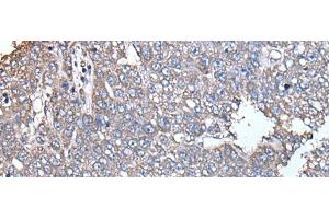 Immunohistochemistry of paraffin-embedded Human liver cancer tissue using SCP2 Polyclonal Antibody at dilution of 1:35(x200)