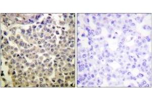 Immunohistochemistry analysis of paraffin-embedded human breast carcinoma, using PAK1/2/3 (Phospho-Thr423/402/421) Antibody.
