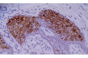 Immunohistochemistry staining of skin basaliom (paraffin-embedded sections) with anti-human Cytokeratin 10 (VIK-10).