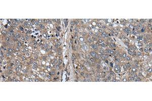 Immunohistochemistry of paraffin-embedded Human liver cancer tissue using ARFGEF1 Polyclonal Antibody at dilution of 1:40(x200)
