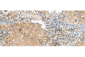 Immunohistochemistry of paraffin-embedded Human cervical cancer tissue using COPE Polyclonal Antibody at dilution of 1:50(x200)