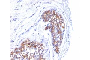 Formalin-fixed, paraffin-embedded human Breast Carcinoma stained with MUC-1 / EMA Mouse Monoclonal Antibody (MUC1/520).