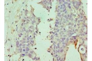 Immunohistochemistry of paraffin-embedded human endometrial cancer using ABIN7149988 at dilution of 1:100