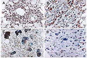 Formalin-fixed paraffin-embedded tissue sections of human glioma stained for Active/Cleaved CASP6 expression.