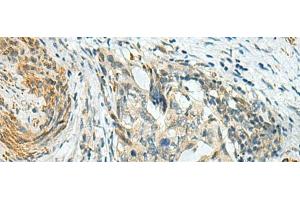 Immunohistochemistry of paraffin-embedded Human cervical cancer tissue using PLPPR5 Polyclonal Antibody at dilution of 1:120(x200)