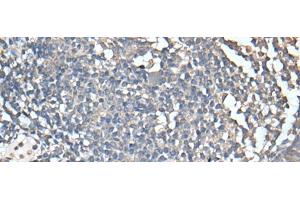Immunohistochemistry of paraffin-embedded Human tonsil tissue using UBASH3A Polyclonal Antibody at dilution of 1:50(x200)
