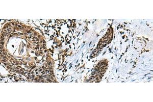 Immunohistochemistry of paraffin-embedded Human esophagus cancer tissue using GLI1 Polyclonal Antibody at dilution of 1:40(x200)