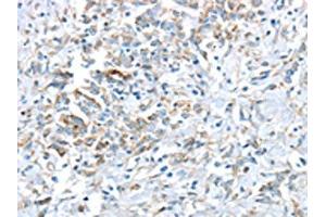 The image on the left is immunohistochemistry of paraffin-embedded Human gastric cancer tissue using ABIN7193036(VWCE Antibody) at dilution 1/30, on the right is treated with synthetic peptide.