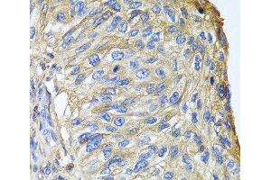Immunohistochemistry of paraffin-embedded Human prostate cancer using APOA1 Polyclonal Antibody at dilution of 1:100 (40x lens).