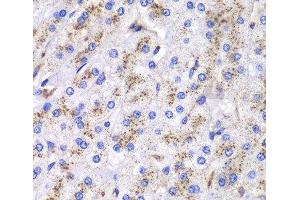 Immunohistochemistry of paraffin-embedded Human liver cancer using CTSD Polyclonal Antibody at dilution of 1:100 (40x lens).