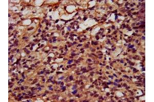 IHC image of ABIN7152727 diluted at 1:400 and staining in paraffin-embedded human ovarian cancer performed on a Leica BondTM system.