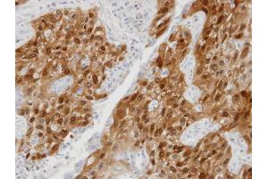 IHC-P Image Immunohistochemical analysis of paraffin-embedded lung SCC xenograft, using DDX5, antibody at 1:100 dilution.