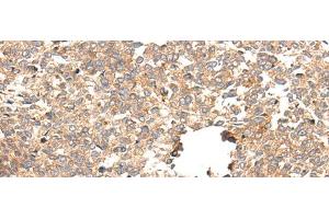 Immunohistochemistry of paraffin-embedded Human esophagus cancer tissue using CACNG5 Polyclonal Antibody at dilution of 1:50(x200)