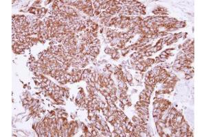 IHC-P Image Immunohistochemical analysis of paraffin-embedded human colon carcinoma, using Angiopoietin 2, antibody at 1:250 dilution.