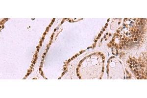 Immunohistochemistry of paraffin-embedded Human thyroid cancer tissue using CUL4A Polyclonal Antibody at dilution of 1:55(x200)