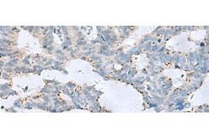 Immunohistochemistry of paraffin-embedded Human colorectal cancer tissue using GPR6 Polyclonal Antibody at dilution of 1:80(x200)