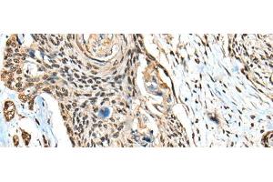 Immunohistochemistry of paraffin-embedded Human esophagus cancer tissue using CBFB Polyclonal Antibody at dilution of 1:40(x200)