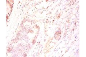 Immunohistochemistry of paraffin-embedded human colon cancer using ABIN7165346 at dilution of 1:50