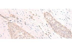 Immunohistochemistry of paraffin-embedded Human esophagus cancer tissue using TBC1D2 Polyclonal Antibody at dilution of 1:25(x200)