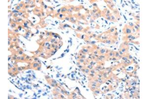 The image on the left is immunohistochemistry of paraffin-embedded Human lung cancer tissue using ABIN7128186(ACSM5 Antibody) at dilution 1/35, on the right is treated with fusion protein.