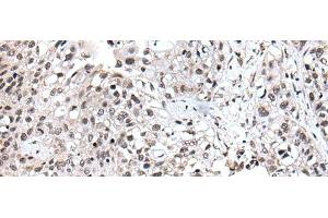 Immunohistochemistry of paraffin-embedded Human lung cancer tissue using UBE2E3 Polyclonal Antibody at dilution of 1:40(x200)