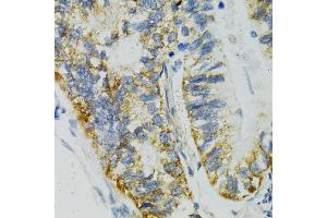 Immunohistochemistry of paraffin-embedded human gastric cancer using SLC27 antibody (ABIN3021377, ABIN3021378, ABIN1513532 and ABIN6214970) at dilution of 1:100 (40x lens).