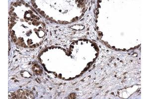 IHC-P Image UBE3A antibody detects UBE3A protein at nucleus on human ovarian carcinoma by immunohistochemical analysis.