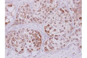 IHC-P Image STMN2 antibody detects STMN2 protein at cytoplasm on human liver carcinoma by immunohistochemical analysis.