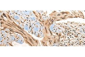 Immunohistochemistry of paraffin-embedded Human breast cancer tissue using CBFB Polyclonal Antibody at dilution of 1:40(x200)