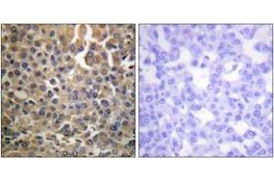 Immunohistochemistry analysis of paraffin-embedded human breast carcinoma, using HER4 (Phospho-Tyr1284) Antibody.