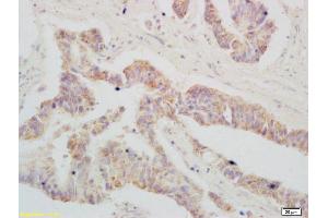Formalin-fixed and paraffin embedded human colon carcinoma labeled with RABBIT ANTI-NOX1/NADPH OXIDASE 1 POLYCLONAL ANTIBODY Unconjugated (ABIN702580) at 1:200 followed by conjugation to the secondary antibody and DAB staining
