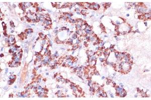 Immunohistochemistry of paraffin-embedded Human thyroid cancer using MRPL23 Polyclonal Antibody at dilution of 1:100 (40x lens).