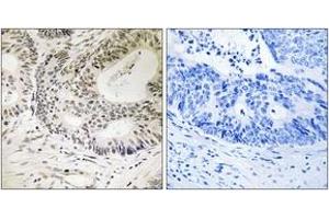 Immunohistochemistry analysis of paraffin-embedded human colon carcinoma, using 53BP1 (Phospho-Ser25) Antibody.