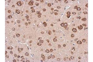 IHC-P Image Immunohistochemical analysis of paraffin-embedded CL1-5 xenograft, using cystatin F, antibody at 1:500 dilution.