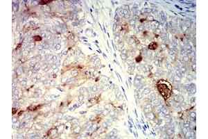Immunohistochemical analysis of paraffin-embedded cervical cancer tissues using CD227 mouse mAb with DAB staining.