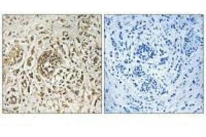 Immunohistochemistry analysis of paraffin-embedded human breast carcinoma tissue, using CIB2 antibody.