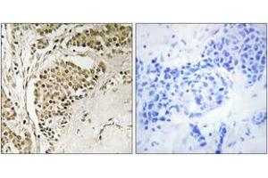 Immunohistochemistry analysis of paraffin-embedded human breast carcinoma tissue, using NOM1 Antibody.