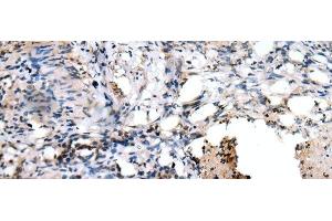 Immunohistochemistry of paraffin-embedded Human lung cancer tissue using PPP1R15A Polyclonal Antibody at dilution of 1:45(x200)