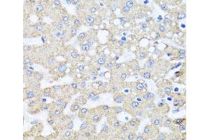 Immunohistochemistry of paraffin-embedded Human liver damage using ARL6 Polyclonal Antibody at dilution of 1:100 (40x lens).