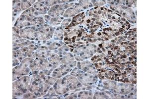 Immunohistochemical staining of paraffin-embedded Adenocarcinoma of colon tissue using anti-RC203219 mouse monoclonal antibody.