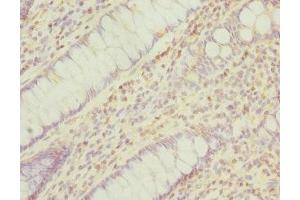 Immunohistochemistry of paraffin-embedded human colon cancer using ABIN7165941 at dilution of 1:100