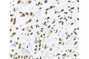 Immunohistochemistry of paraffin-embedded Human lung cancer using JNK1 Polyclonal Antibody at dilution of 1:100 (40x lens).