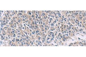 Immunohistochemistry of paraffin-embedded Human colorectal cancer tissue using PROKR2 Polyclonal Antibody at dilution of 1:40(x200)