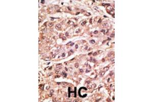 Image no. 3 for anti-Small Ubiquitin Related Modifier 4 (SUMO4) (Met55Val-Mutant) antibody (ABIN2996873)