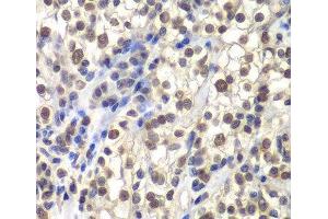 Immunohistochemistry of paraffin-embedded Human kidney cancer using CENPC Polyclonal Antibody at dilution of 1:200 (40x lens).