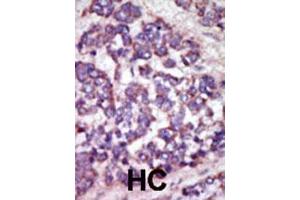 Image no. 2 for anti-LATS, Large Tumor Suppressor, Homolog 1 (Drosophila) (LATS1) (AA 1-30), (N-Term) antibody (ABIN391033)