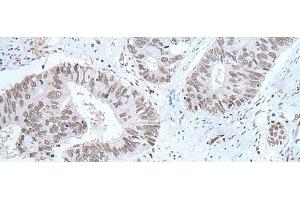 Immunohistochemistry of paraffin-embedded Human colorectal cancer tissue using HCRT Polyclonal Antibody at dilution of 1:25(x200)