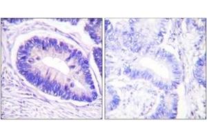 Immunohistochemistry analysis of paraffin-embedded human colon carcinoma, using MYPT1 (Phospho-Thr853) Antibody.
