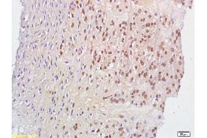 Formalin-fixed and paraffin embedded human cervical carcinoma labeled with Anti-phospho-Acinus(Ser1180) Polyclonal Antibody, Unconjugated (ABIN682708) at 1:200 followed by conjugation to the secondary antibody and DAB staining.